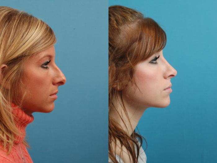 Before & After Rhinoplasty Case 129 Right Side View in West Des Moines & Ames, IA