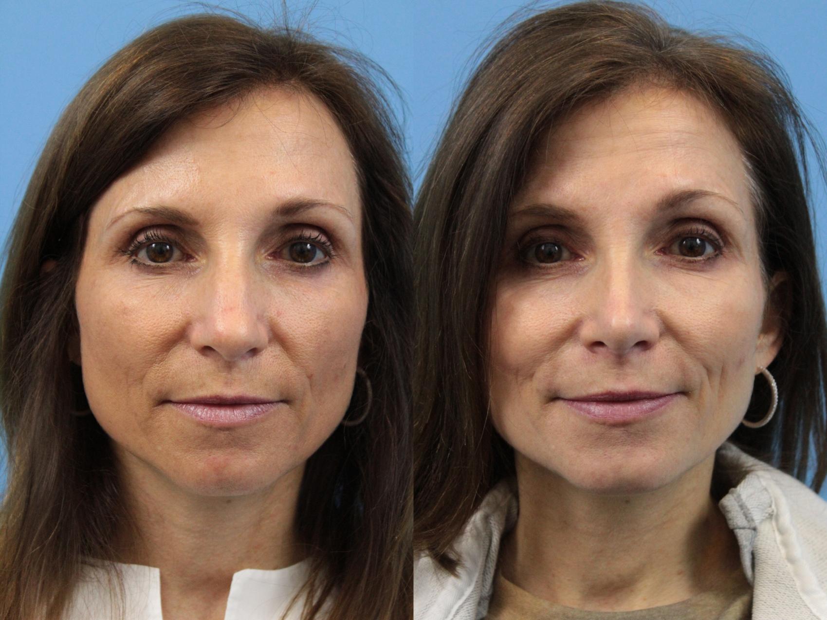 Before & After Rhinoplasty Case 143 View #1 View in West Des Moines & Ames, IA
