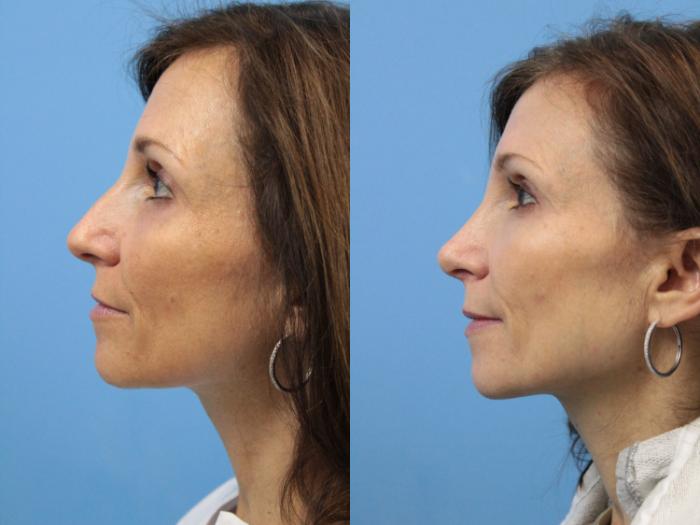 Before & After Rhinoplasty Case 143 View #2 View in West Des Moines & Ames, IA