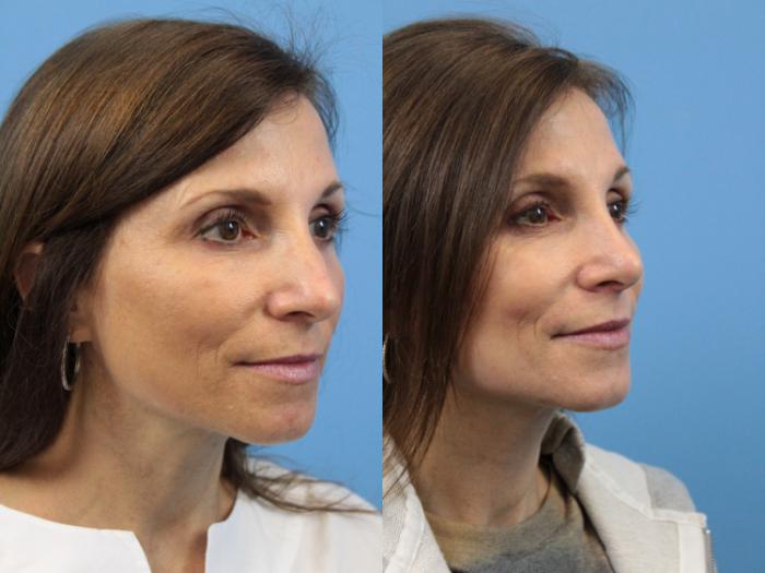 Before & After Rhinoplasty Case 143 View #3 View in West Des Moines & Ames, IA