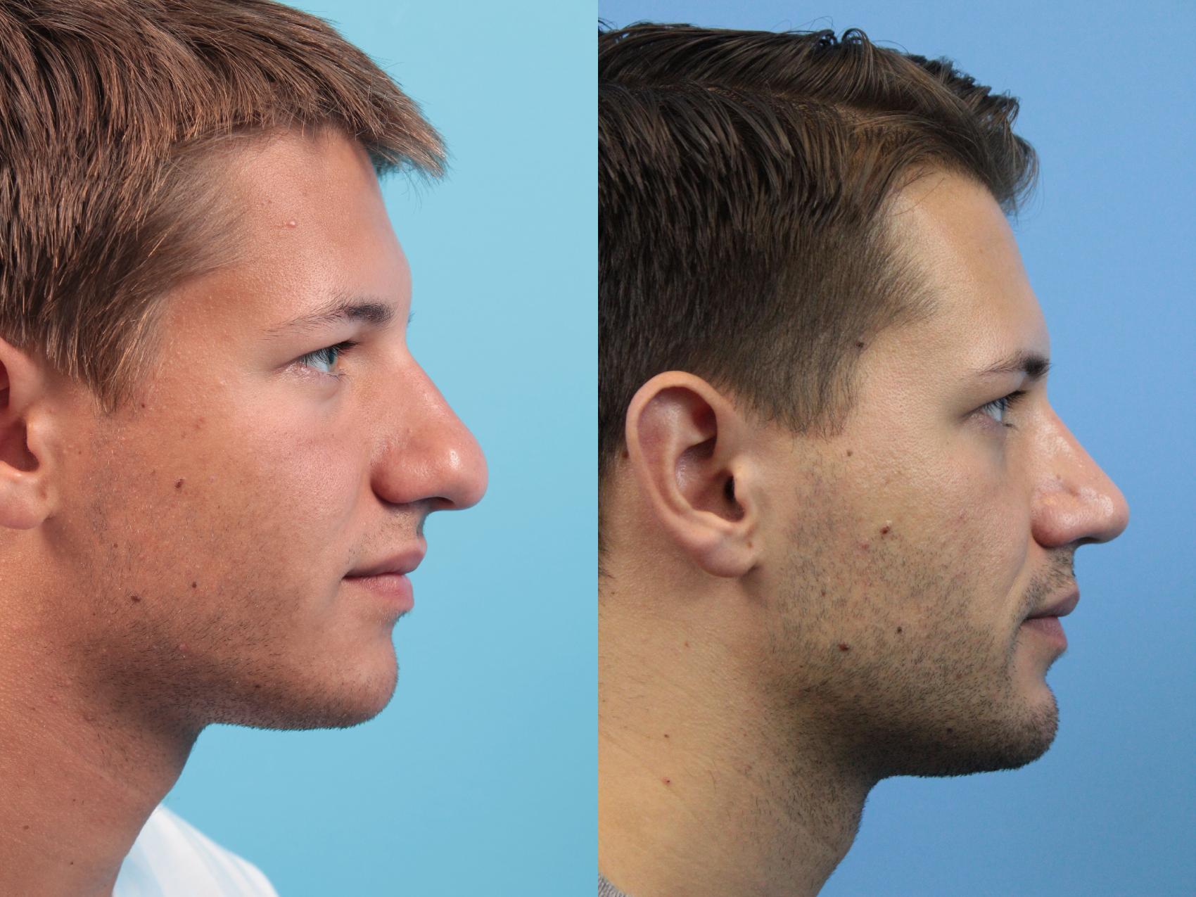 Before & After Rhinoplasty Case 144 View #1 View in West Des Moines, IA