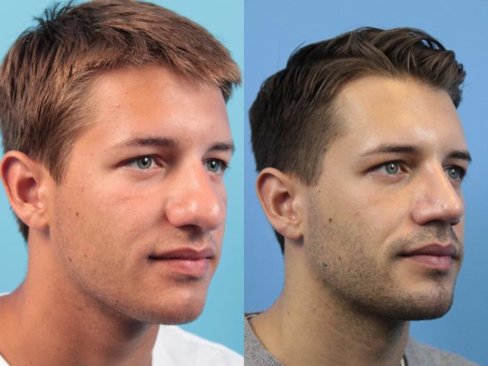 Before & After Rhinoplasty Case 144 View #2 View in West Des Moines & Ames, IA