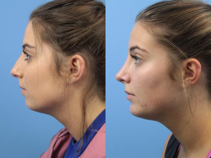 Before & After Chin Augmentation Case 146 View #2 View in West Des Moines & Ames, IA