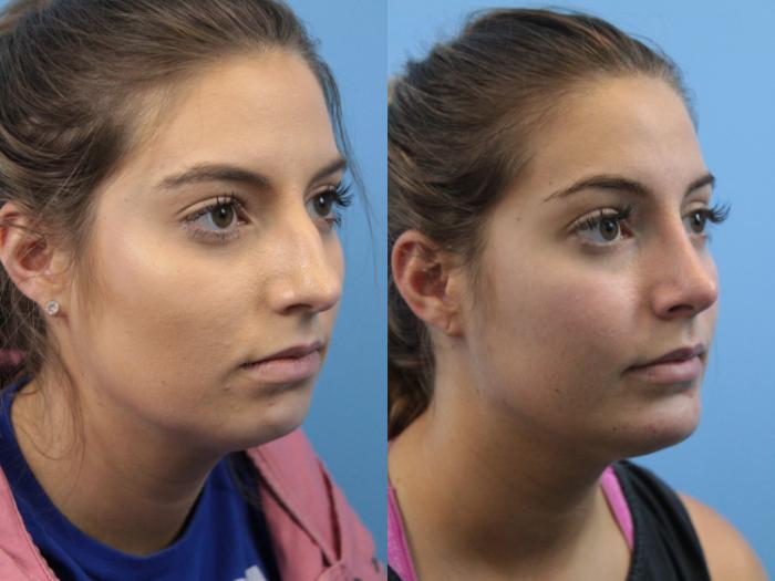 Before & After Chin Augmentation Case 146 View #3 View in West Des Moines & Ames, IA