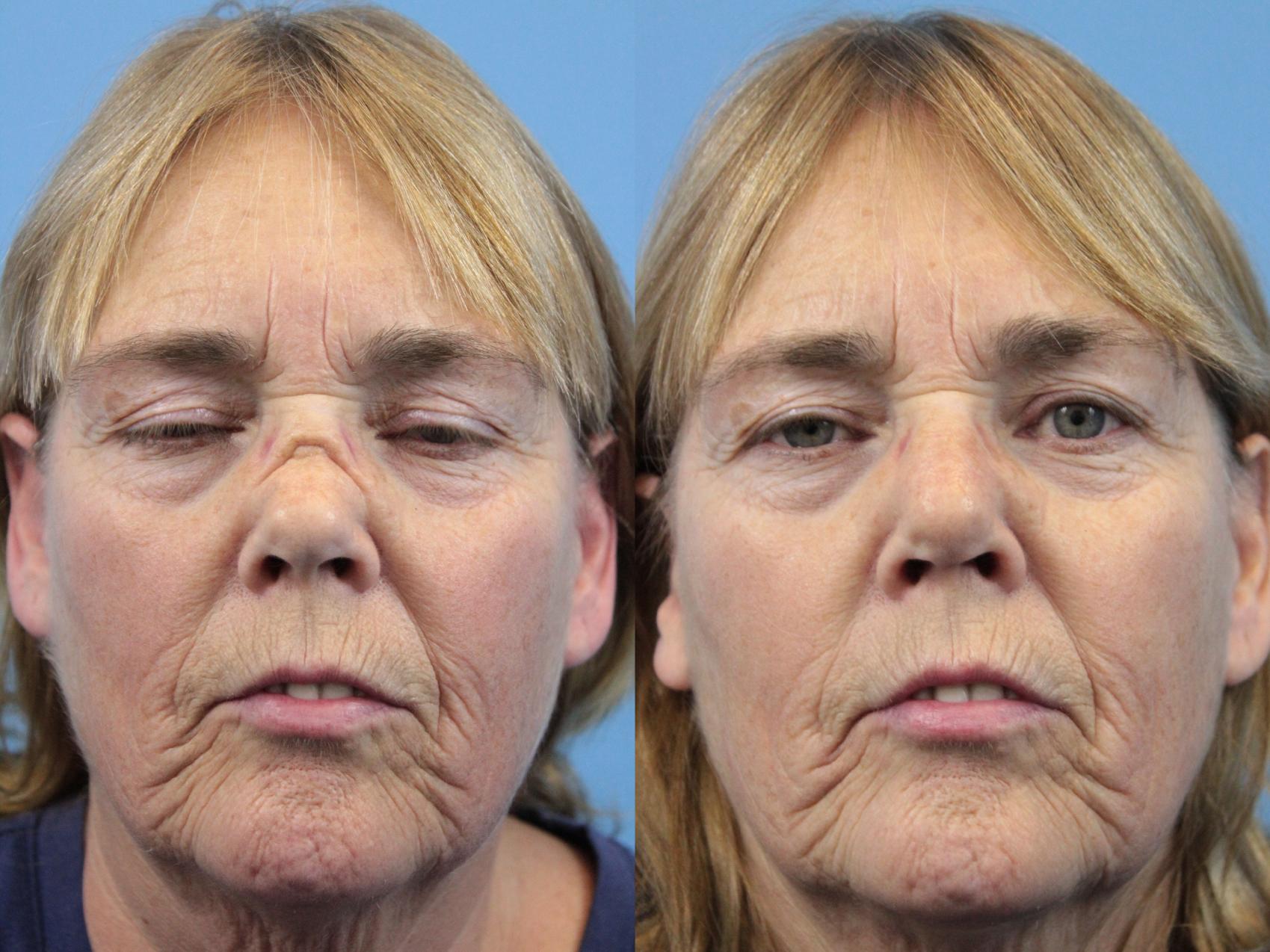Before & After Rhinoplasty Case 151 Front View in West Des Moines & Ames, IA