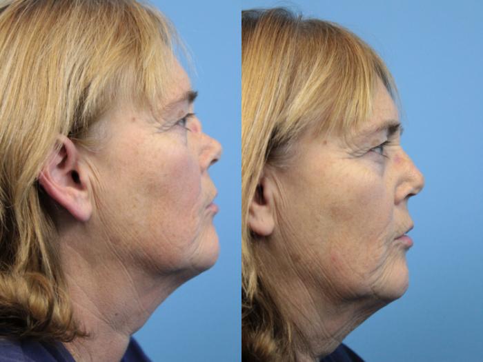 Before & After Rhinoplasty Case 151 View #2 View in West Des Moines & Ames, IA