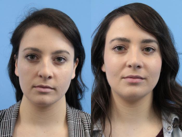 Before & After Rhinoplasty Case 152 Front View in West Des Moines & Ames, IA