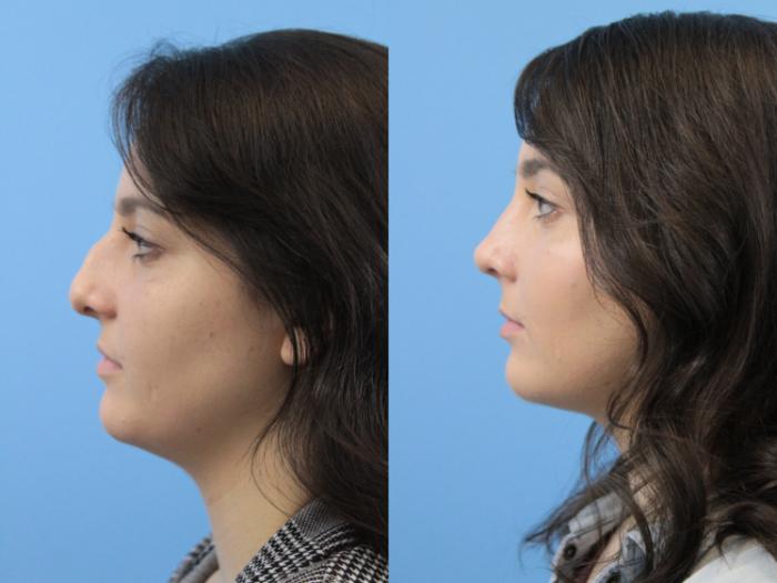 Before & After Rhinoplasty Case 152 Left Side View in West Des Moines & Ames, IA