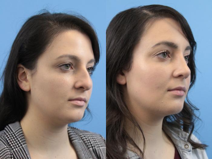 Before & After Rhinoplasty Case 152 Right Oblique View in West Des Moines & Ames, IA