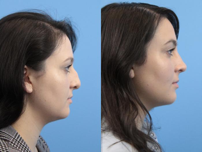 Before & After Rhinoplasty Case 152 Right Side View in West Des Moines & Ames, IA