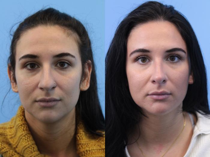 Before & After Rhinoplasty Case 162 Front View in West Des Moines & Ames, IA