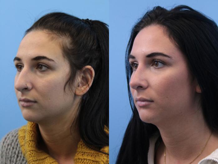 Before & After Rhinoplasty Case 162 Left Oblique View in West Des Moines & Ames, IA