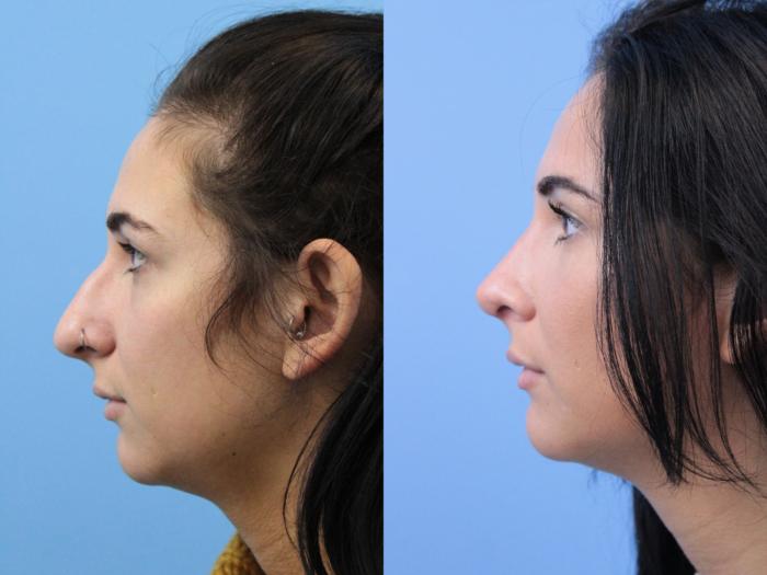 Before & After Rhinoplasty Case 162 Left Side View in West Des Moines & Ames, IA