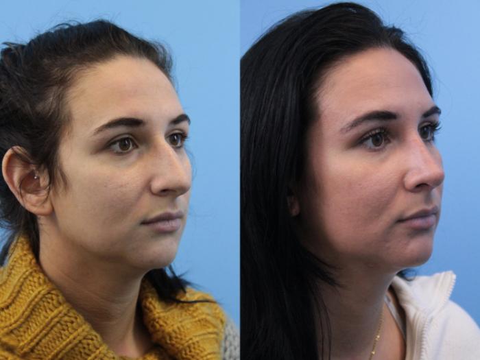 Before & After Rhinoplasty Case 162 Right Oblique View in West Des Moines & Ames, IA