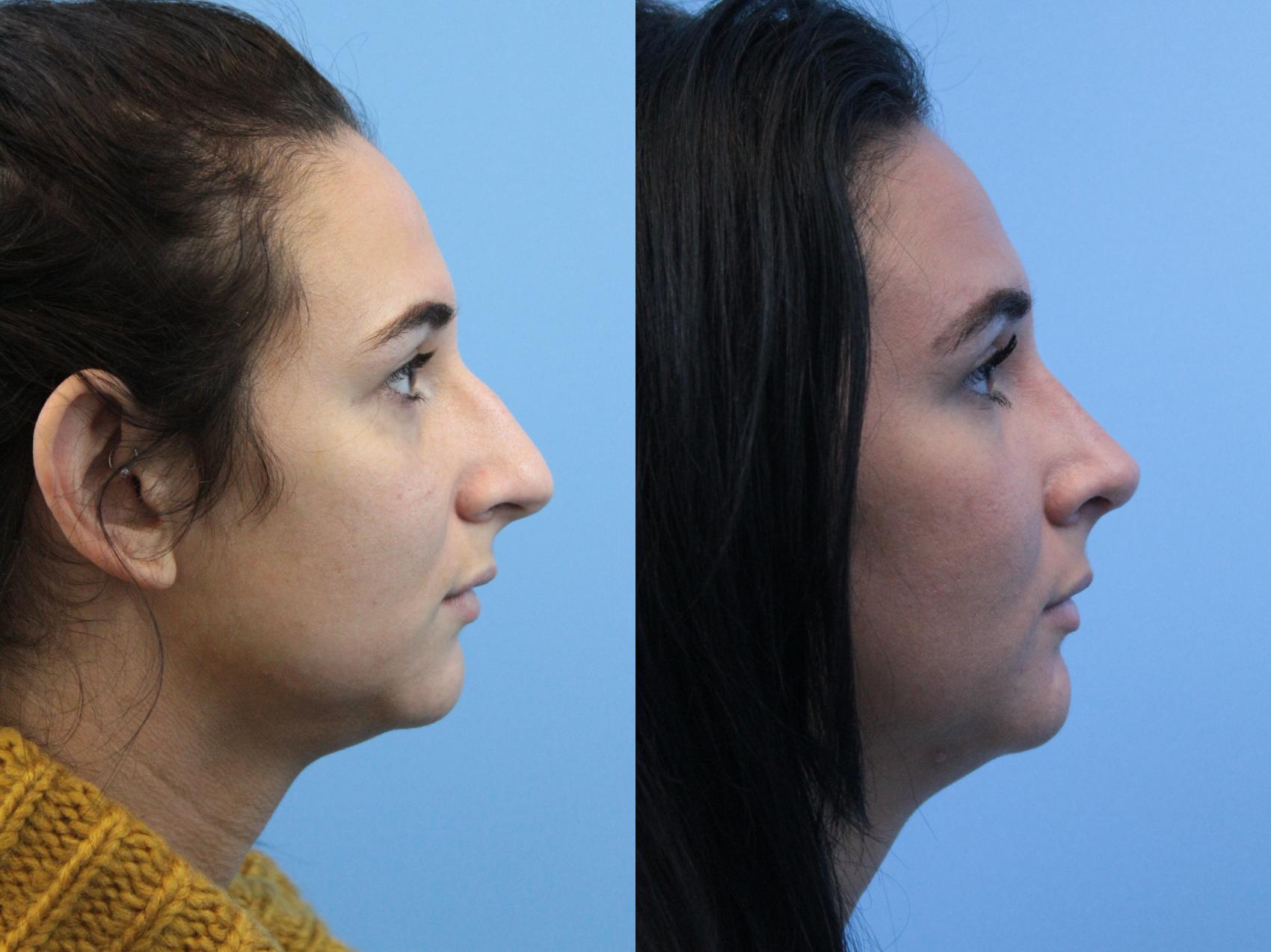 Before & After Rhinoplasty Case 162 Right Side View in West Des Moines & Ames, IA
