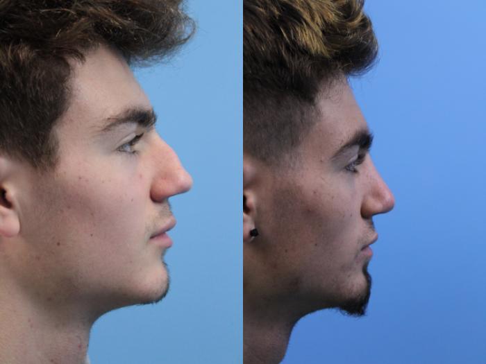 Before & After Rhinoplasty Case 166 View #1 View in West Des Moines & Ames, IA
