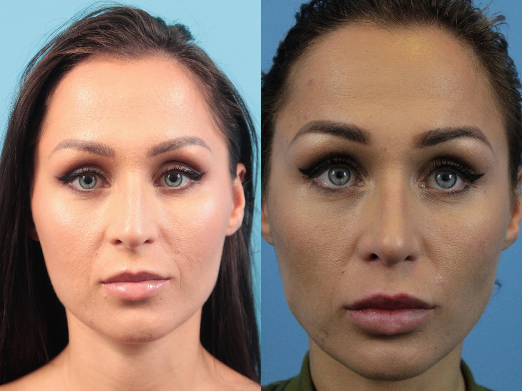 Before & After Rhinoplasty Case 168 View #1 View in West Des Moines & Ames, IA