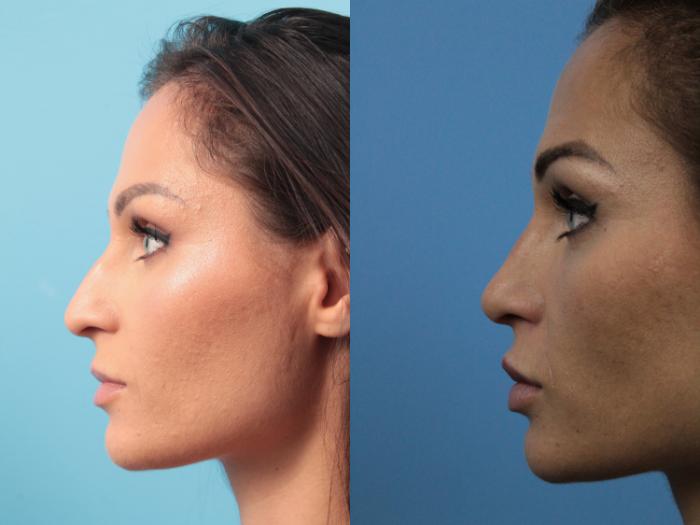 Before & After Rhinoplasty Case 168 View #2 View in West Des Moines & Ames, IA