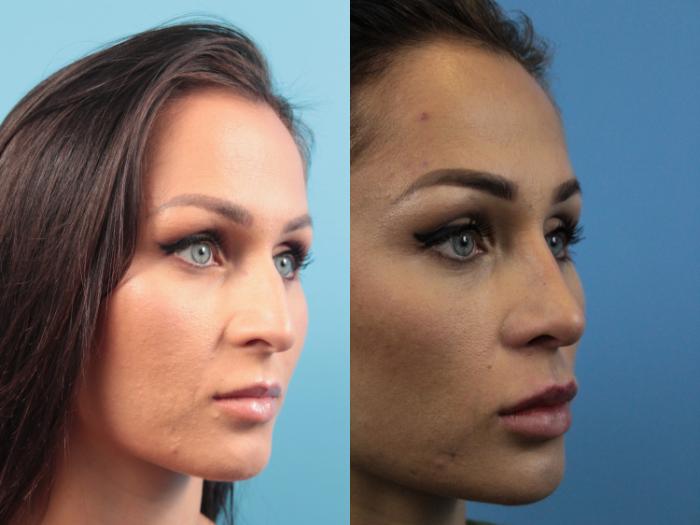 Before & After Rhinoplasty Case 168 View #3 View in West Des Moines & Ames, IA