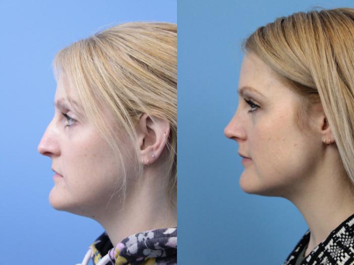 Before & After Rhinoplasty Case 171 View #2 View in West Des Moines & Ames, IA