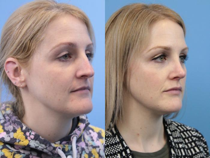 Before & After Rhinoplasty Case 171 View #3 View in West Des Moines & Ames, IA