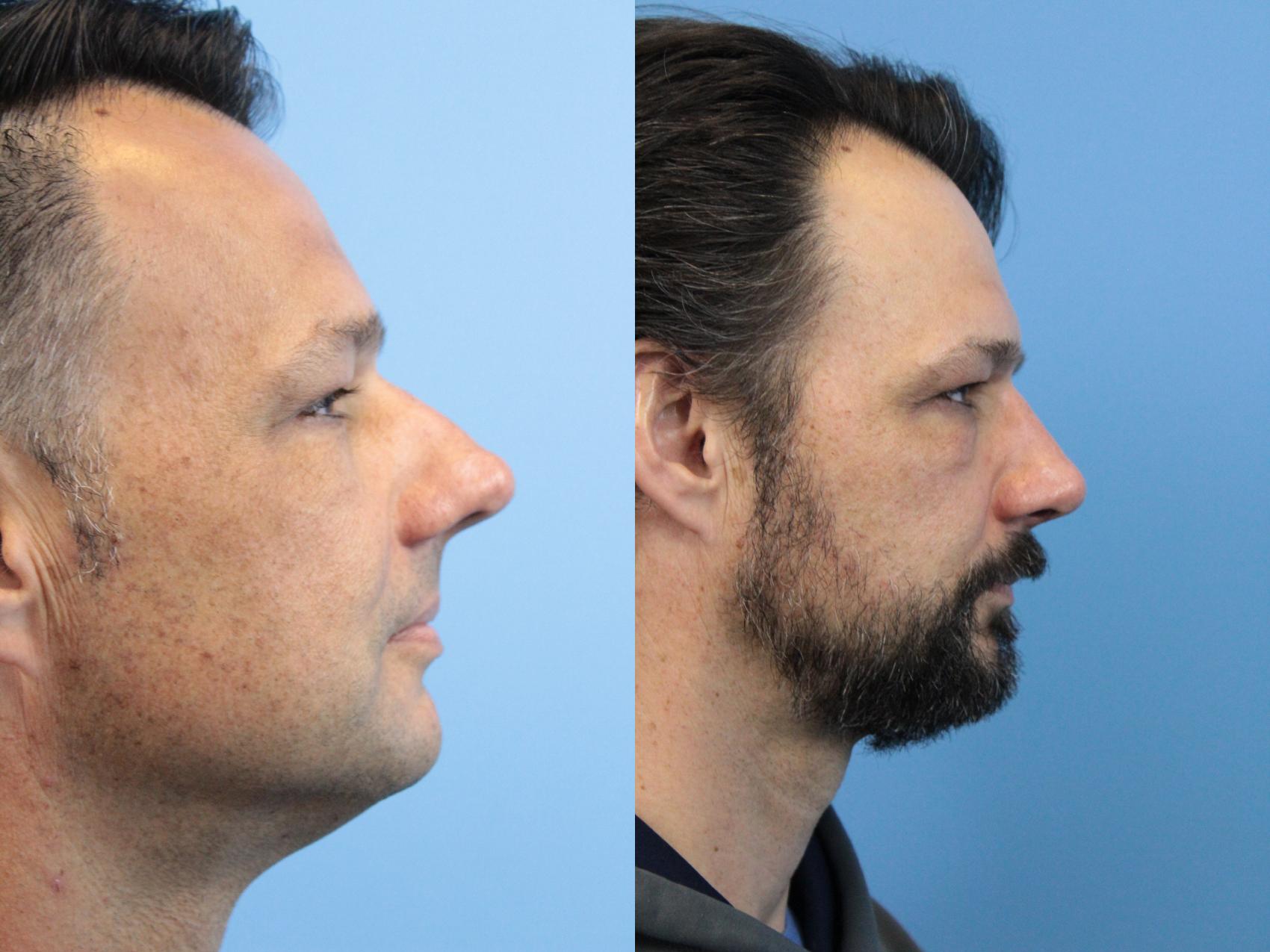 Before & After Rhinoplasty Case 174 View #1 View in West Des Moines & Ames, IA