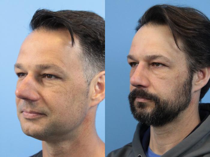 Before & After Rhinoplasty Case 174 View #3 View in West Des Moines & Ames, IA