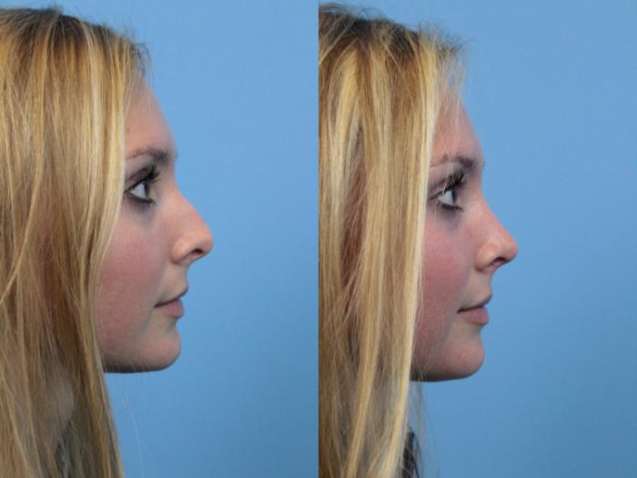 Before & After Rhinoplasty Case 176 View #2 View in West Des Moines & Ames, IA