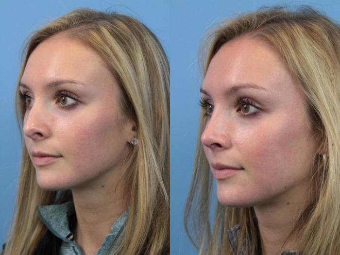Before & After Rhinoplasty Case 176 View #3 View in West Des Moines & Ames, IA