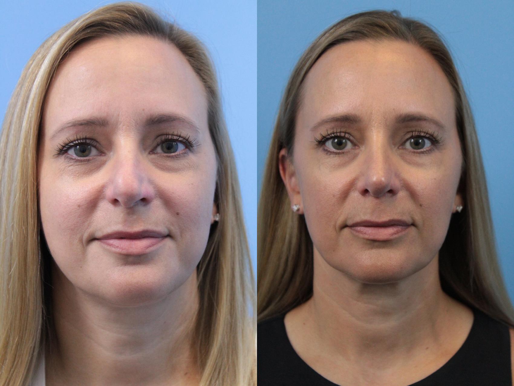 Before & After Rhinoplasty Case 180 View #1 View in West Des Moines & Ames, IA