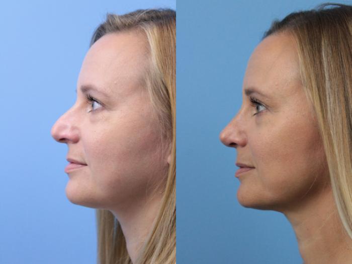 Before & After Rhinoplasty Case 180 View #2 View in West Des Moines & Ames, IA