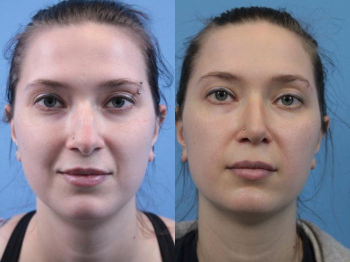 Before & After Rhinoplasty Case 182 View #1 View in West Des Moines & Ames, IA