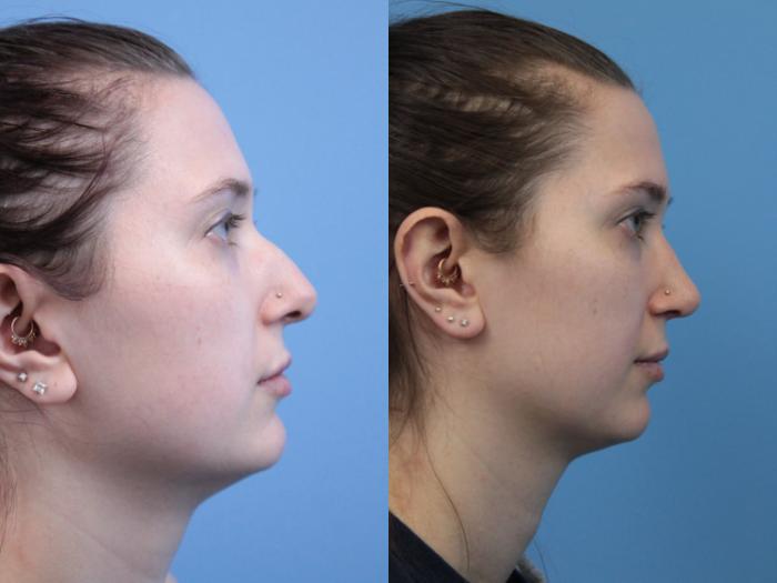Before & After Rhinoplasty Case 182 View #2 View in West Des Moines & Ames, IA