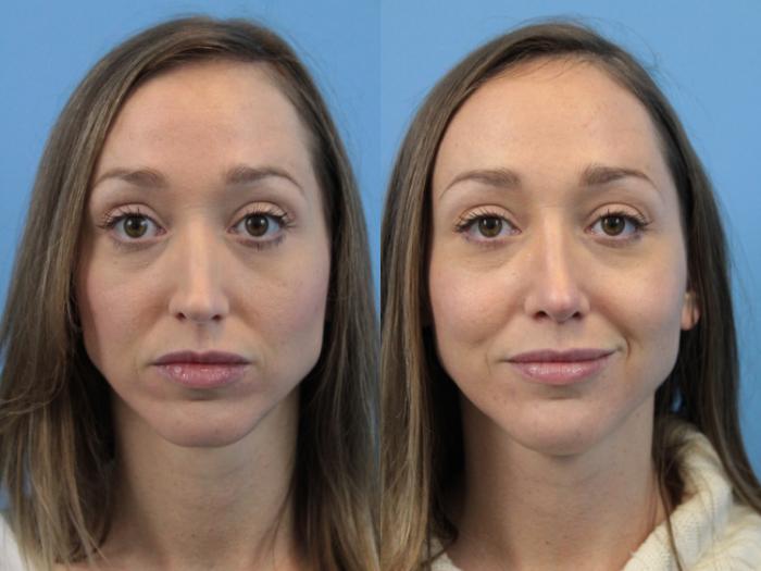 Before & After Rhinoplasty Case 189 Front View in West Des Moines & Ames, IA