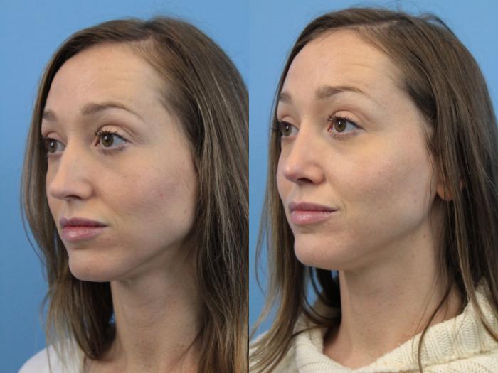 Before & After Rhinoplasty Case 189 Left Oblique View in West Des Moines & Ames, IA