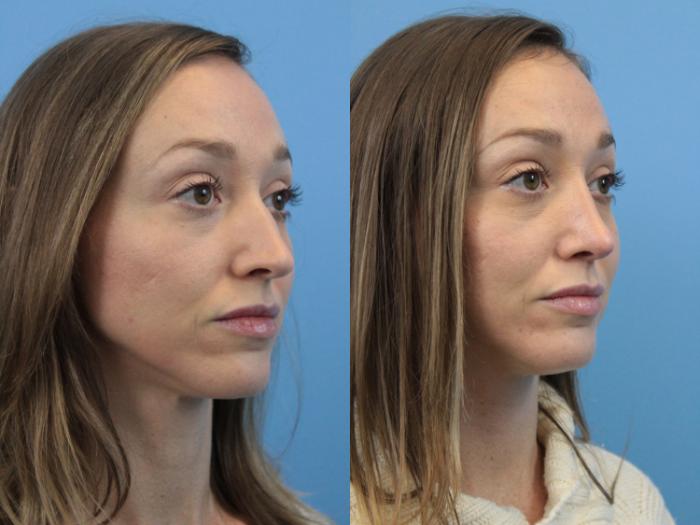 Before & After Rhinoplasty Case 189 Right Oblique View in West Des Moines & Ames, IA