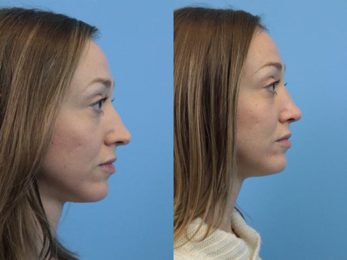 Before & After Rhinoplasty Case 189 Right Side View in West Des Moines & Ames, IA
