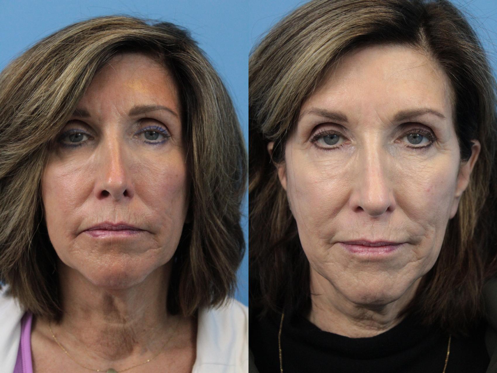Before & After Rhinoplasty Case 191 Front View in West Des Moines & Ames, IA