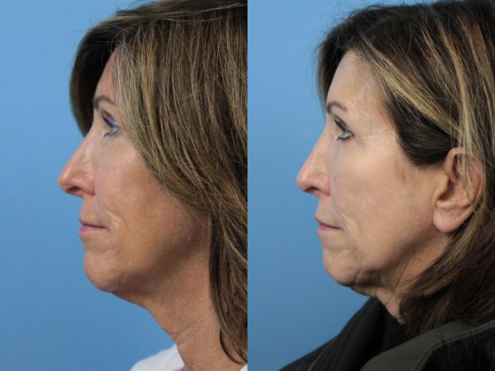 Before & After Rhinoplasty Case 191 Left Side View in West Des Moines & Ames, IA
