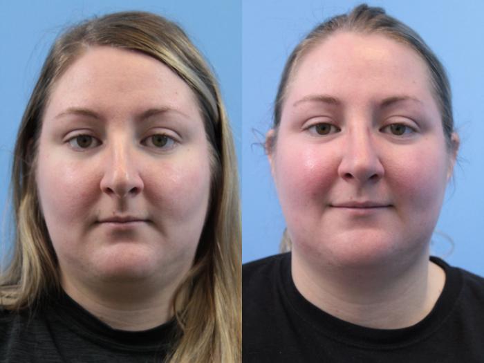 Before & After Rhinoplasty Case 196 Front View in West Des Moines & Ames, IA