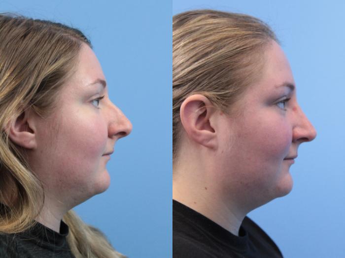 Before & After Rhinoplasty Case 196 Right Side View in West Des Moines & Ames, IA