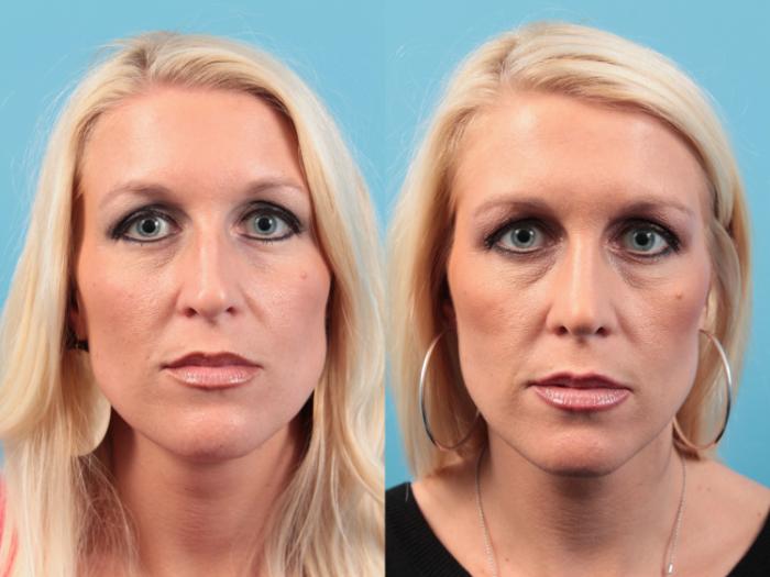 Before & After Rhinoplasty Case 20 Front View in West Des Moines & Ames, IA