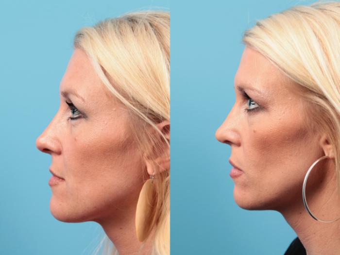 Before & After Rhinoplasty Case 20 Left Side View in West Des Moines & Ames, IA