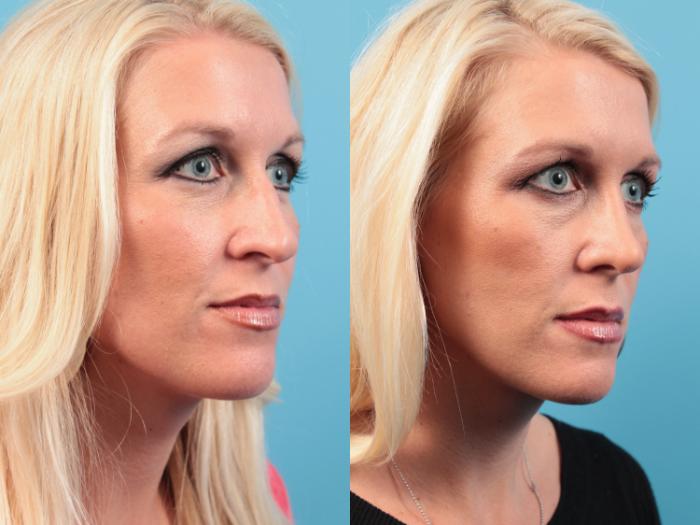 Before & After Rhinoplasty Case 20 Right Oblique View in West Des Moines & Ames, IA