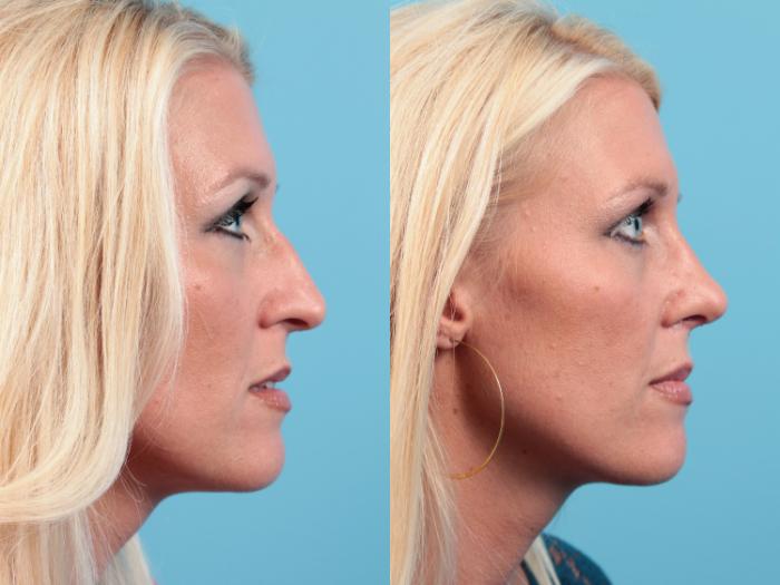 Before & After Rhinoplasty Case 20 Right Side View in West Des Moines & Ames, IA