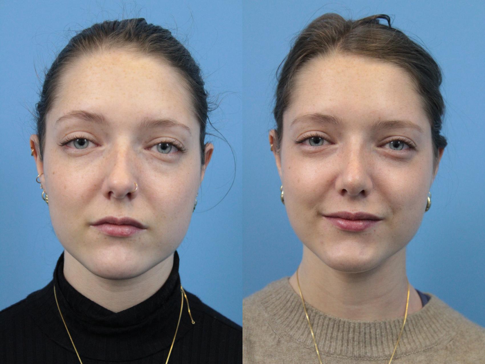 Before & After Rhinoplasty Case 202 Front View in West Des Moines & Ames, IA