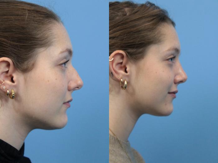Before & After Rhinoplasty Case 202 Right Side View in West Des Moines & Ames, IA