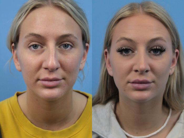 Before & After Rhinoplasty Case 214 Front View in West Des Moines & Ames, IA