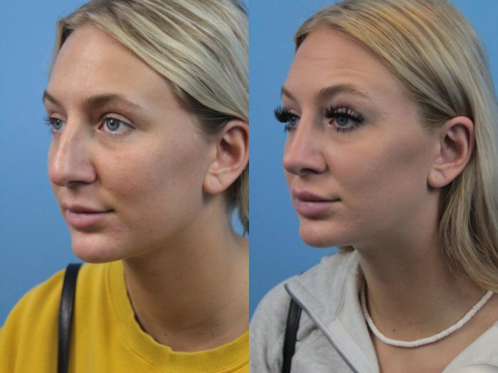 Before & After Rhinoplasty Case 214 Left Oblique View in West Des Moines & Ames, IA