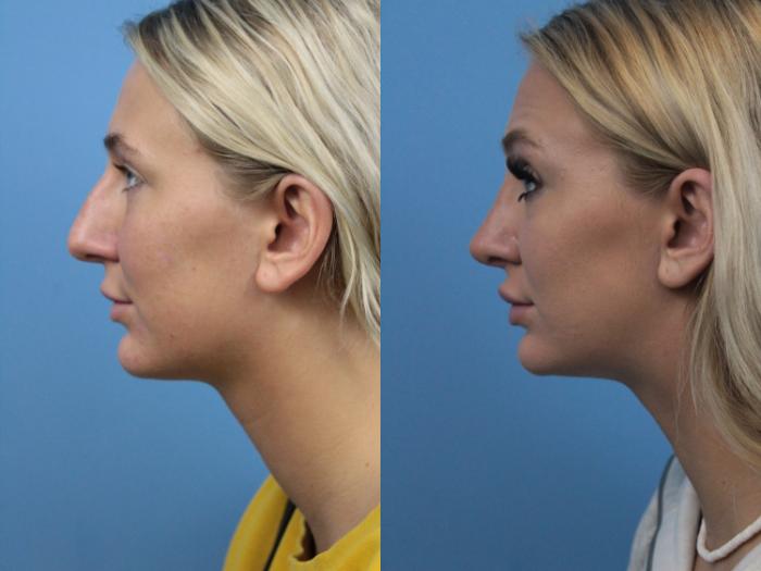 Before & After Rhinoplasty Case 214 Left Side View in West Des Moines & Ames, IA